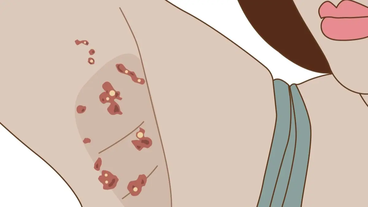 Medizinische Illustration mit entzündlichen Knoten und Laesionen in der Achselhoehle als typisches Bild der Hidradenitis suppurativa
