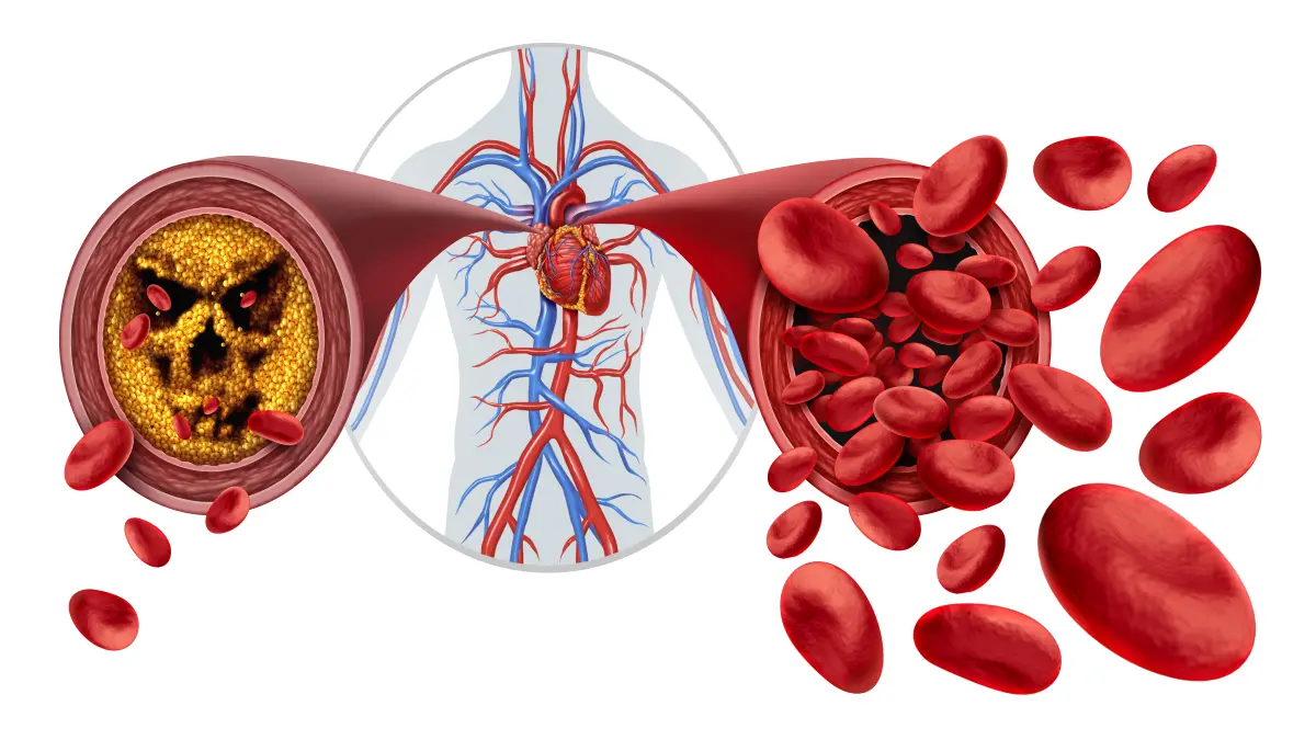 Illustration einer atherosklerotisch verengten Arterie mit Plaque-Ablagerungen im Vergleich zu einer gesunden Arterie mit frei fließenden Blutzellen