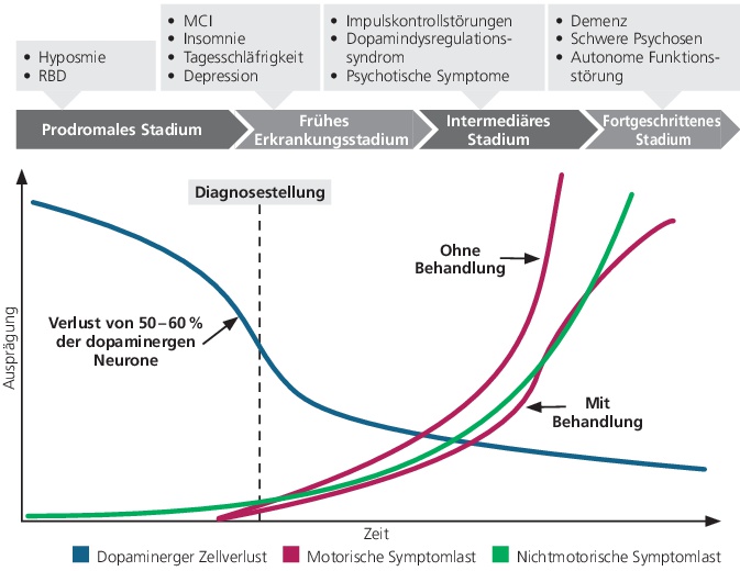 Abb. 1: Die ersten motorischen Symptome der Parkinson-Krankheit (PK) treten auf, wenn bereits mehr als die Hälfte der dopaminergen Neurone untergegangen ist. Die nicht-motorischen Symptome beginnen jedoch oft schon mehrere Jahre zuvor. Während nach Diagnosestellung sowohl motorische als auch nicht-motorische Symptome fortschreiten, lassen sich erstere häufig noch gut medikamentös dopaminerg kontrollieren. Im Verlauf werden zunehmend die NMS zur therapeutischen Herausforderung. Die Abbildung zeigt den Verlauf schematisch, sowohl der individuelle Krankheitsverlauf als auch der Zeitpunkt der Diagnosestellung können dabei stark variieren; mod. nach [6].