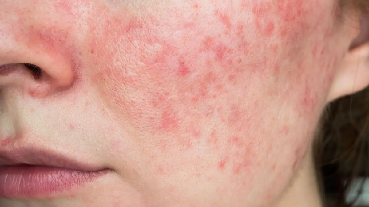 Nahaufnahme von geroeteter und entzündeter Haut im Wangenbereich als typisches Bild einer Rosacea