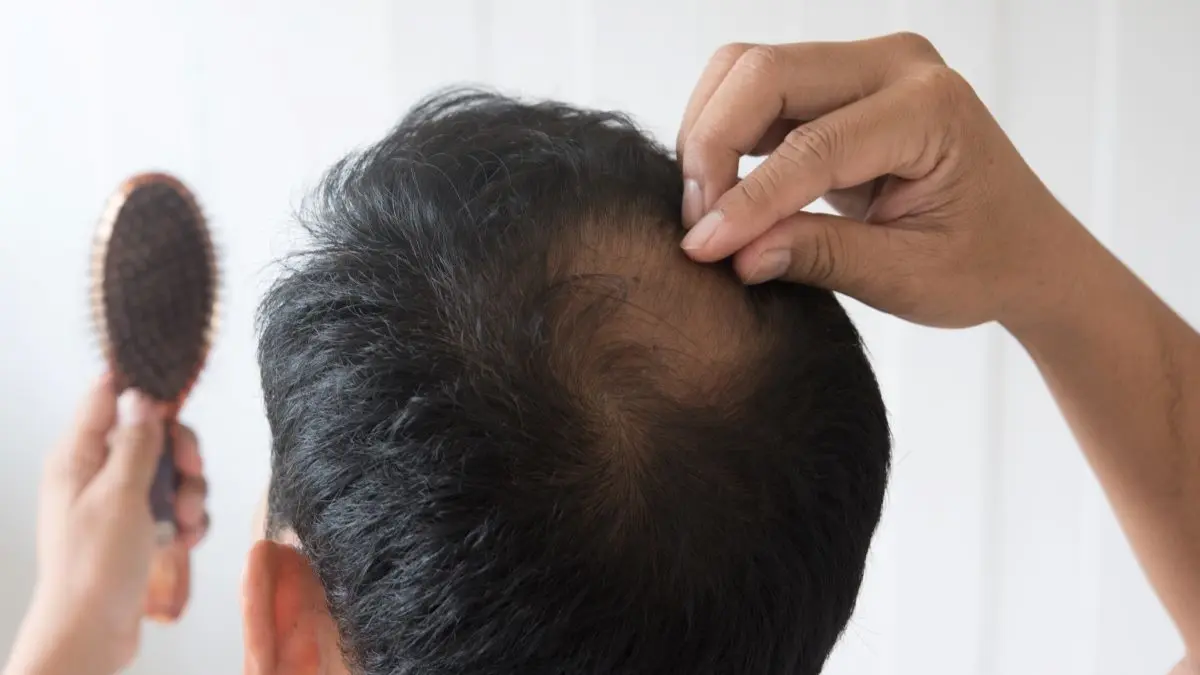 Person betrachtet eine kahle Stelle am Hinterkopf im Spiegel, Symbolbild fuer kreisrunden Haarausfall (Alopecia areata)