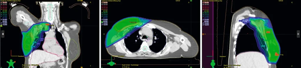 Exemplarische Dosisverteilung einer adjuvanten Radiotherapie der Brust inklusive der Lymphabflusswege in drei
Ebenen.