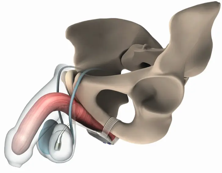 Abb. 1: ATOMS (Adjustable Transobturator Male System, AMI, Österreich)