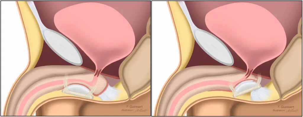 Abb. 2: links: ATOMS Standard Implantation, rechts: ATOMS mit proximaler Implantation, gut sichtbar wird der urethrale Bulbus und teilweise der urethrale Sphinkter direkt unterstützt.