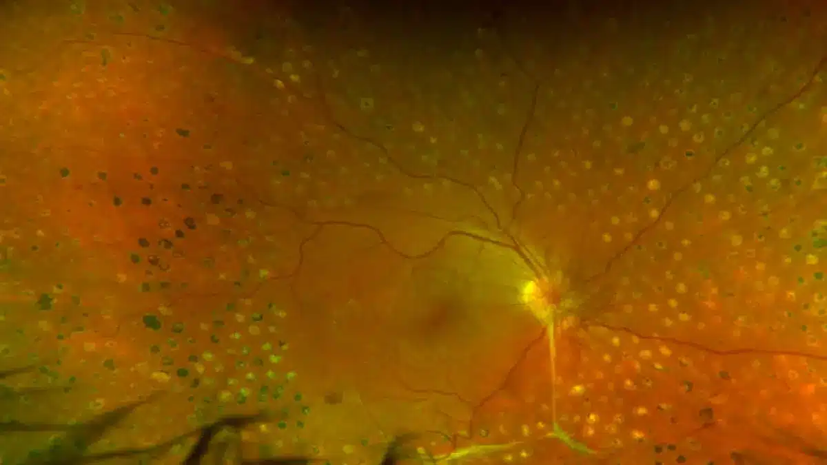 Panretinale Laserkoagulation