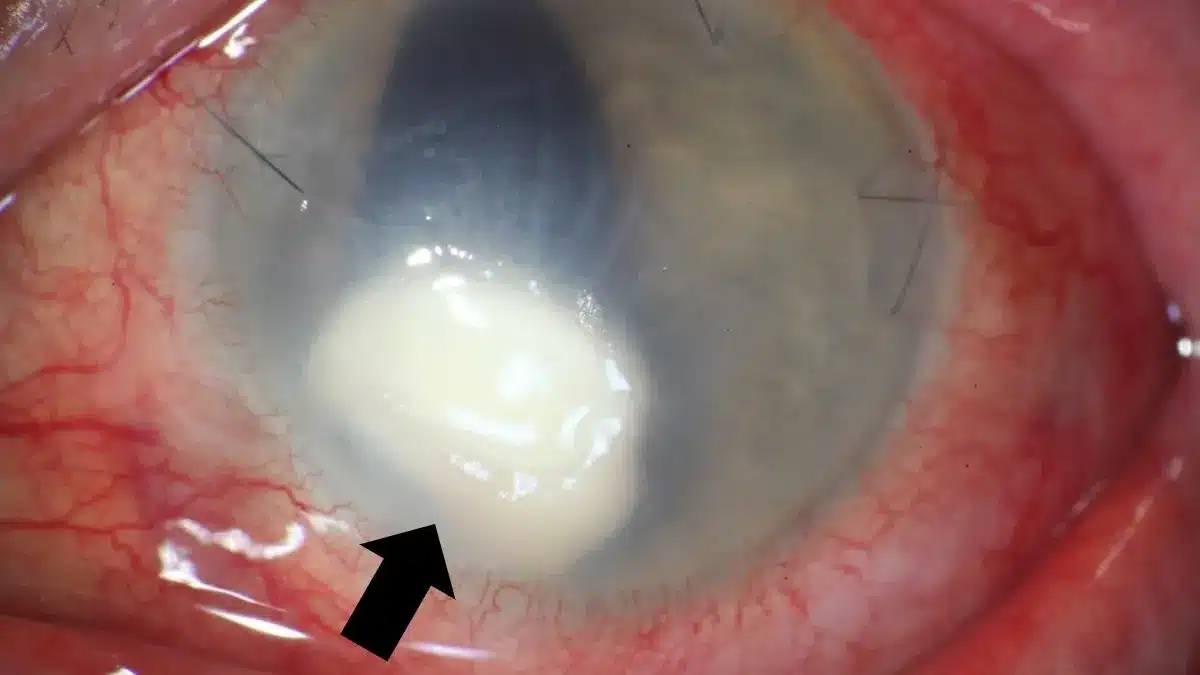 Pilzkeratitis Kornea