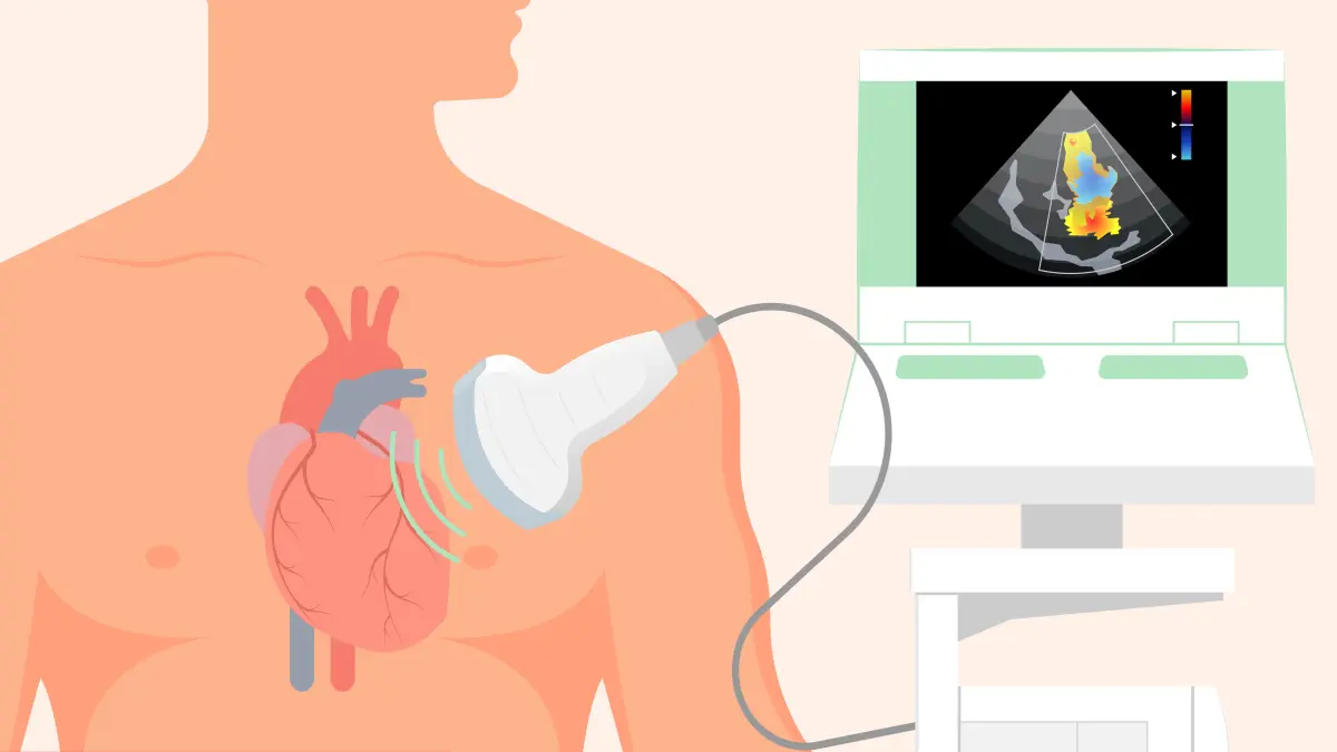 Schematische Darstellung einer Echokardiographie mit Farbdoppler – Diagnostik bei Mitralklappeninsuffizienz