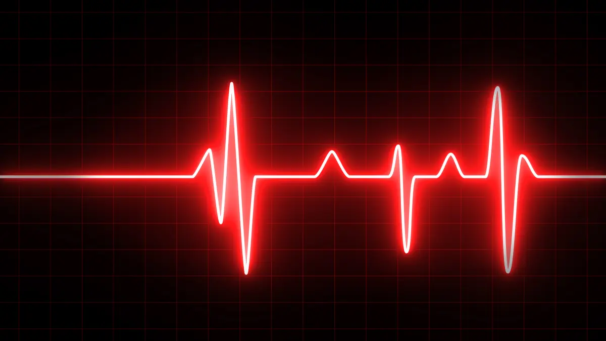 EKG-Kurve zur Darstellung von Herzrhythmusstörungen bei Herzinsuffizienz mit reduzierter Ejektionsfraktion