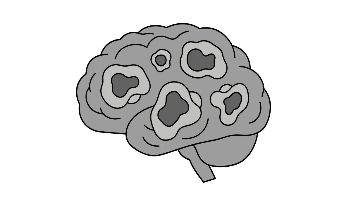 Schematische Illustration eines Gehirns mit mehreren Tumorherden als Symbolbild fuer Epstein-Barr-Virus-assoziierte Hirnlymphome