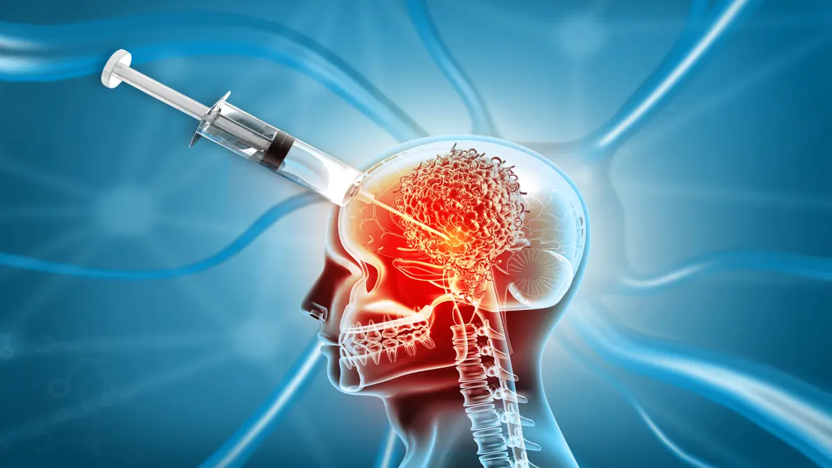 3D-Illustration eines menschlichen Kopfes im Röntgenstil mit sichtbarem Hirntumor und einer Spritze als Symbol für die Impftherapie gegen Gliome