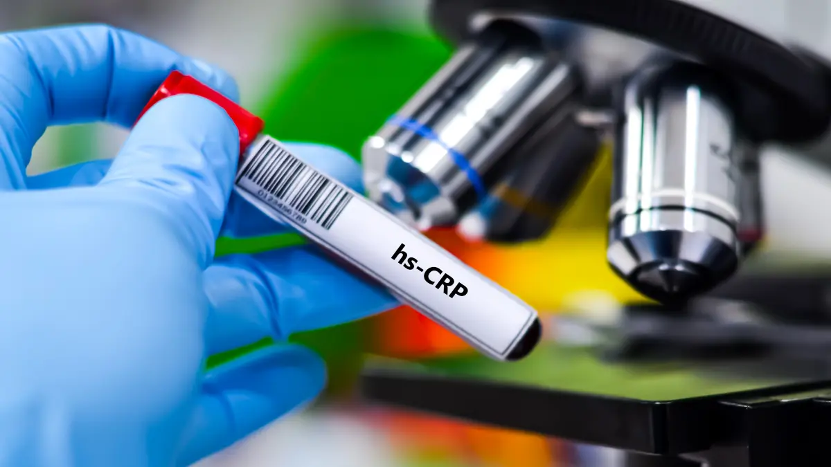 Handschuhbekleidete Hand hält ein beschriftetes Blutröhrchen mit der Aufschrift hs-CRP vor einem Mikroskop im Labor – Biomarker zur Messung kardiovaskulärer Inflammation