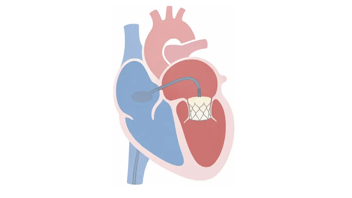 Schematische Illustration einer Transkatheter-Mitralklappenprothese (TMVR) im Herzen – interventionelle Mitralklappentherapie bei Mitralklappeninsuffizienz