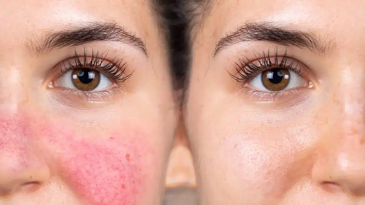 Symbolbild mit einer Gesichtshaelfte mit starker Roetung und einer Seite mit unauffaelliger Haut als Hinweis auf Rosacea als neuroimmunologische Erkrankung