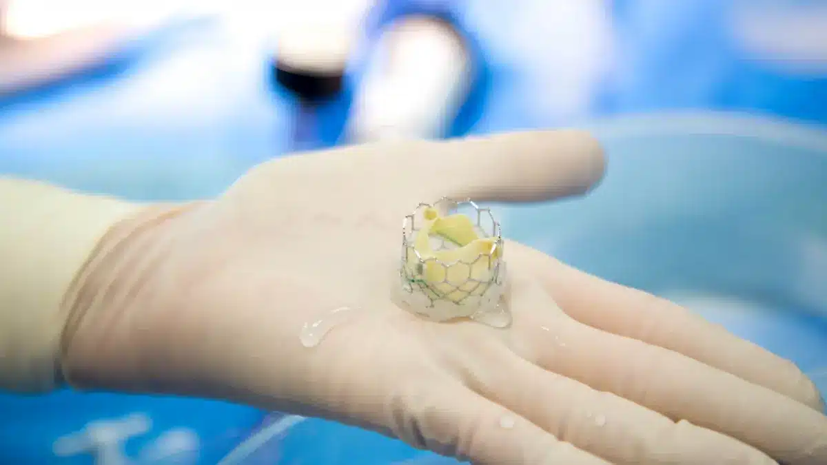 TAVI-Klappenprothese auf Chirurgenhand im OP – interventionelle Therapie der Aortenklappenstenose mit Transkatheter-Aortenklappenimplantation