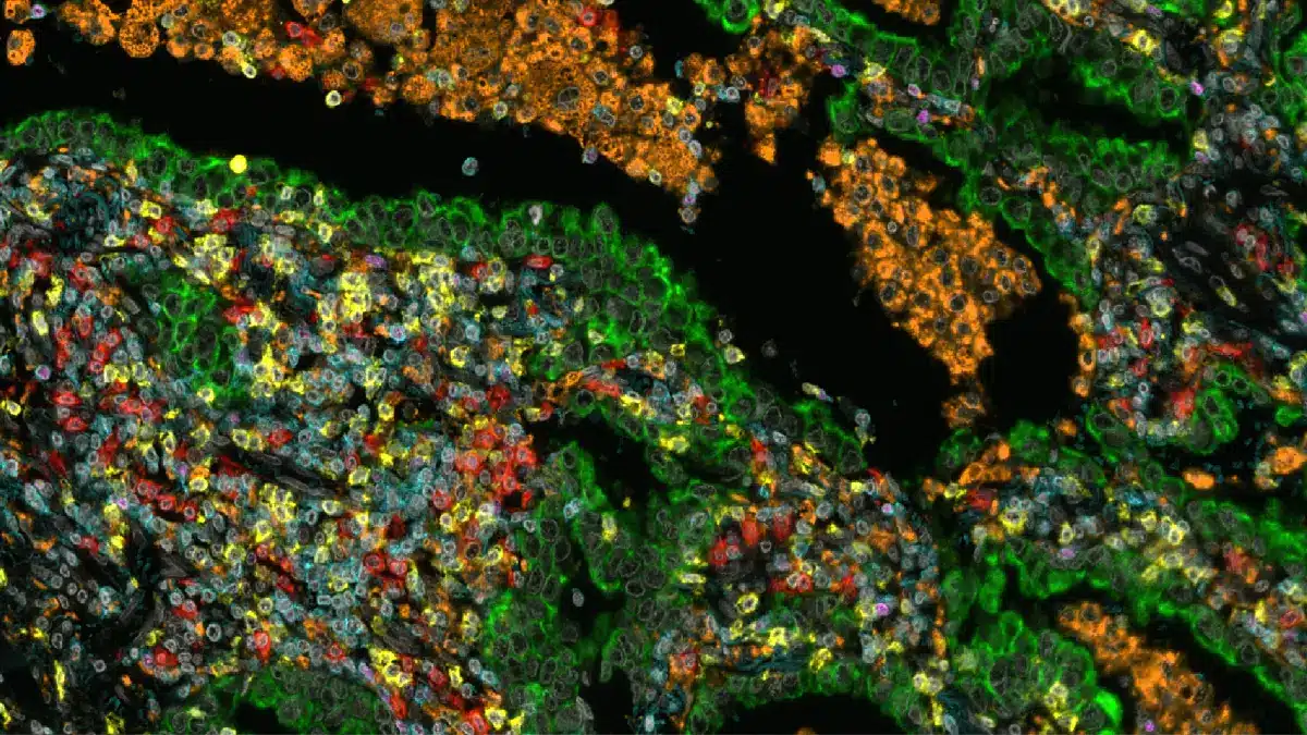 Multiplex-Immunfluoreszenz eines nicht-kleinzelligen Lungentumors mit verschiedenfarbig markierten Immunzellen im Tumorstroma