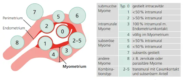 Abb. 3: Schematische Darstellung der Myomklassifikation nach FIGO. Übersicht der Myomtypen anhand ihrer Lagebeziehung zu Endometrium, Myometrium und Perimetrium (links) sowie tabellarische Zuordnung der einzelnen Typen (rechts).