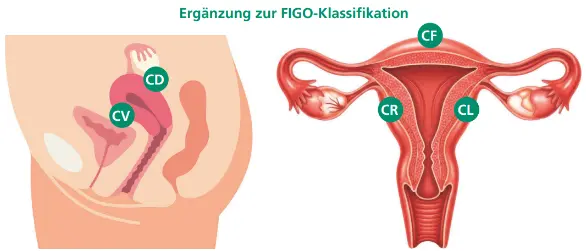 Abb. 4: Von M. David und A. D. Ebert (2025) vorgeschlagene Ergänzung der FIGO- Klassifikation von Myomen zur Lokalisation bezüglich Seiten-, Vorder- oder Hin- terwand bwz. Fundus. CD: Corpus dorsal; CV: Corpus ventral; CF: Corpus-Fundus; CL: Corpus links; CR: Corpus rechts.
© koti – stock.adobe.com und © Mia – stock.adobe.com (modifiziert)
