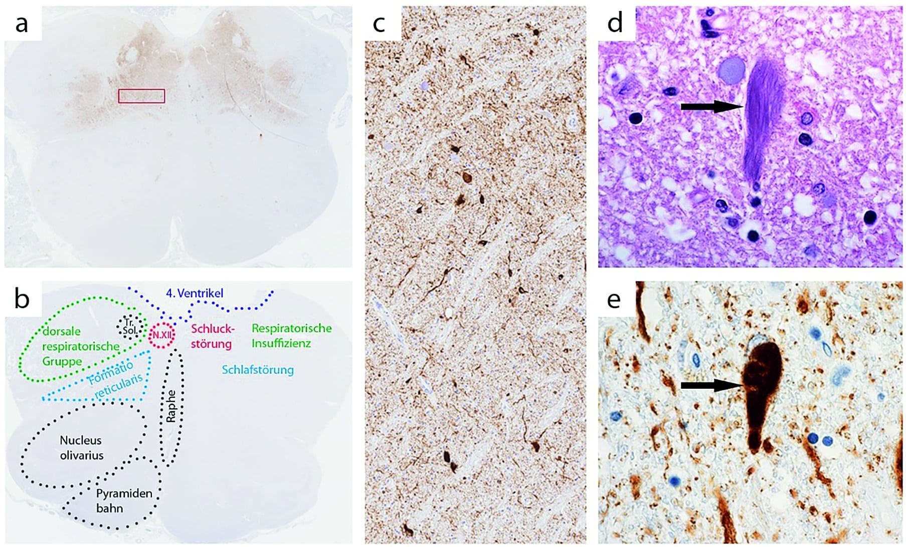 Färbemuster mittels Anti-Tau-Immunhistochemie (Antikörper AT8) in der Medulla oblongata bei einem/einer Patienten/in in Stadium 3 (a,c) und Stadium 1 (b) der Tau-Pathologie der anti-IgLON5 Erkrankung. In (b) weiter ersichtlich die Kerngebiete sowie ihre klinischen Korrelate bei Erkrankung (N.XII entspricht Nucleus Hypoglossus, Tr. Sol. entspricht Tractus Solitarius). Die Markierung in (a) zeigt sich vergrößert in (c). In (d) zu erkennen ein neuronaler neurofibrillärer „Tangle“ in der konventionellen Hämatoxylin-Eosin-Färbung (Pfeil). In (e) zeigt sich ebenso ein Tau positiver „Tangle“ mit reichlich Tau positiven umgebenden Neuriten nach immunhistochemischer Färbung mittels AT8. 