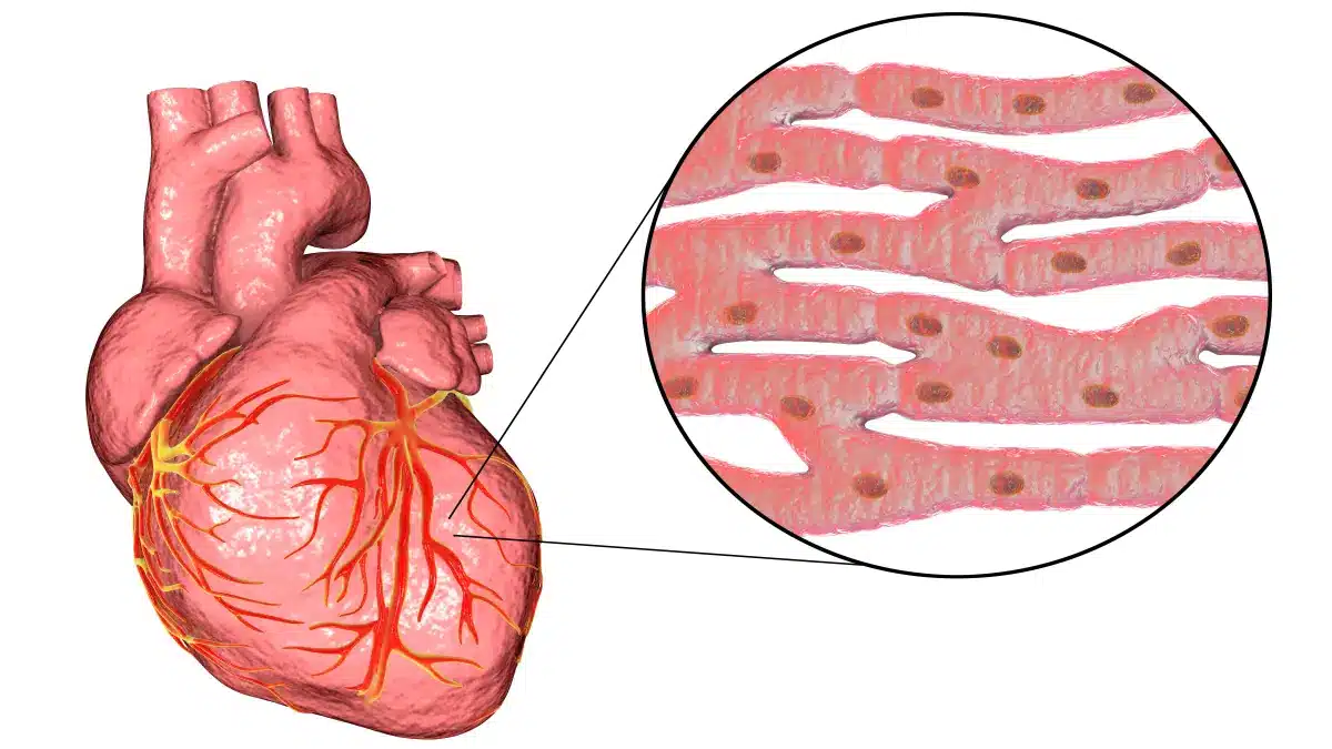Anatomische Darstellung des Herzens mit vergrößerter Ansicht der Herzmuskelzellen – Illustration zur RBM20-Kardiomyopathie