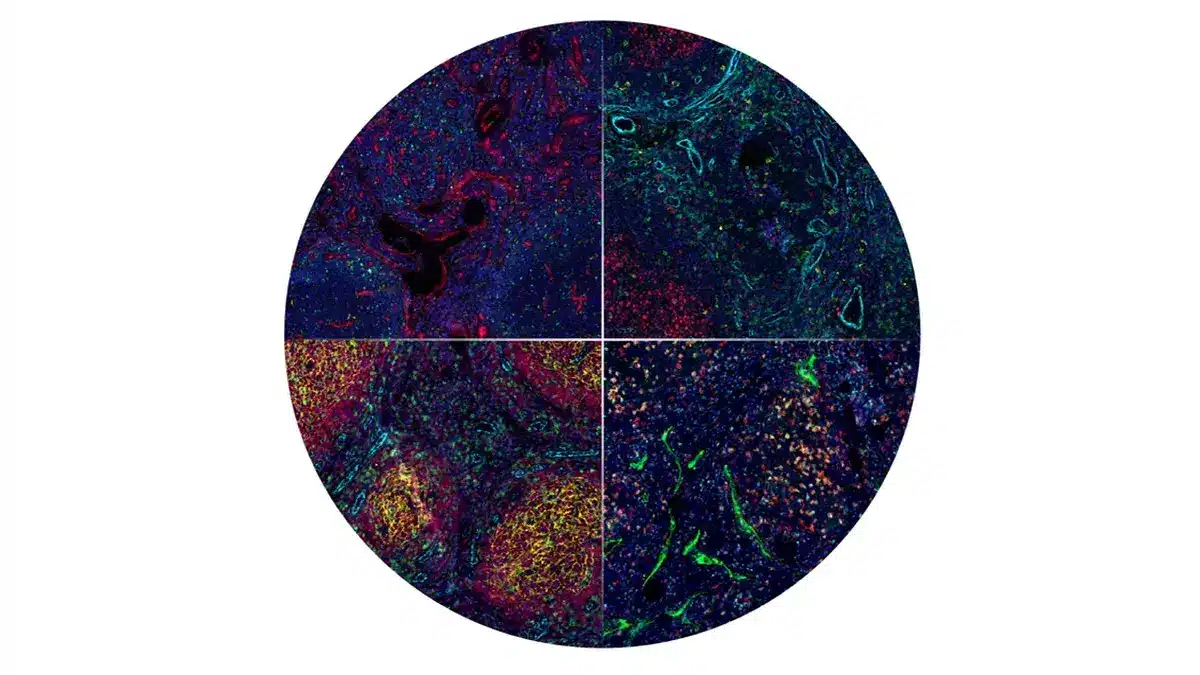 Runde Multiplex-Immunfluoreszenzaufnahme mit vier Gewebeschnitten, die unterschiedliche Zellverteilungen in Lymphomgewebe zeigt
