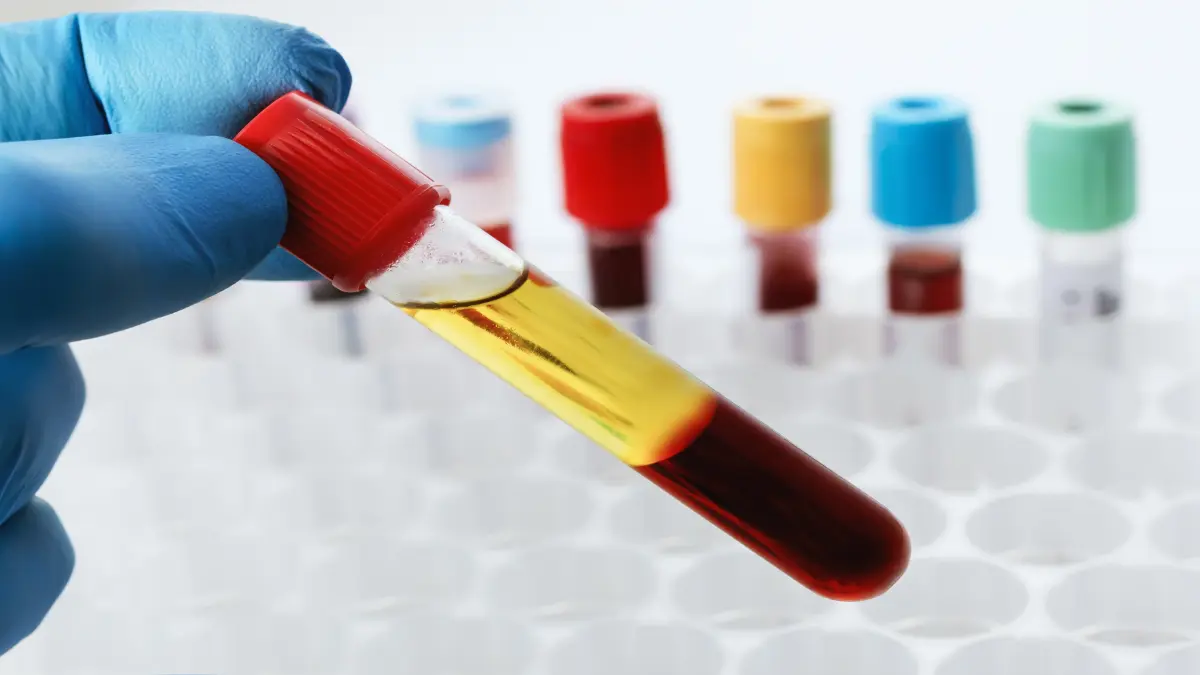 Blutprobe im Labor als Symbol für die Messung von Transthyretin bei Transthyretin-Amyloidose mit Kardiomyopathie.