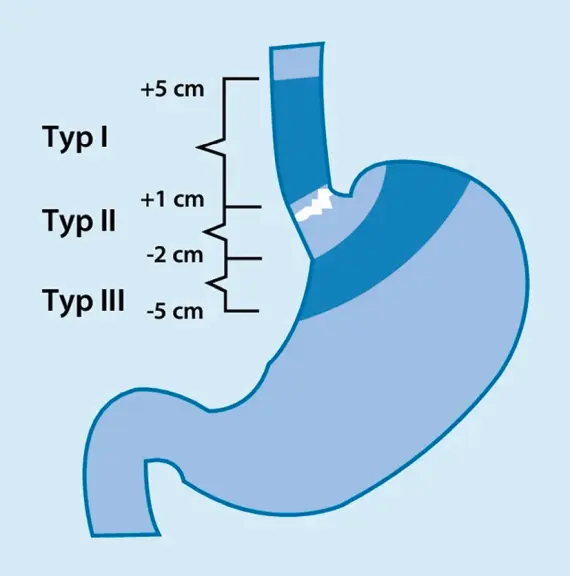 Schematische Darstellung von Speiseroehre und Magen mit Einteilung der Adenokarzinome des gastrooesophagealen Uebergangs in Typ I, Typ II und Typ III nach Lage des Tumorzentrums in Zentimetern