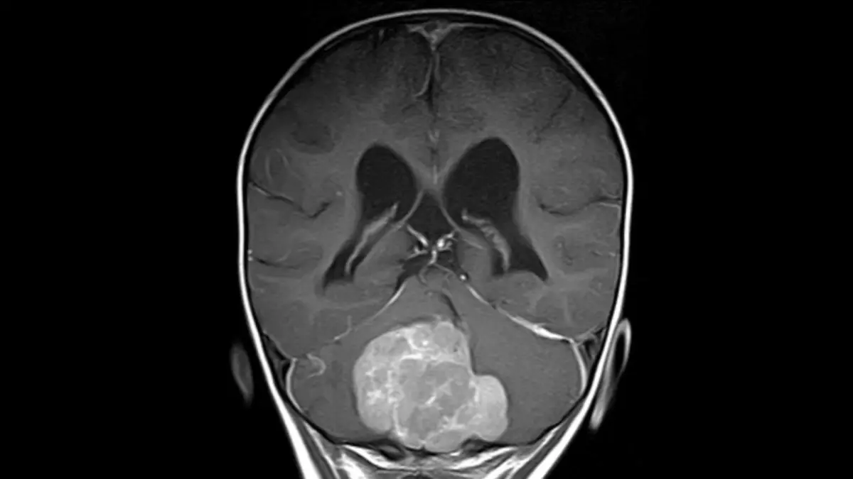 MRT-Aufnahme eines kindlichen Schaedels in Frontalansicht mit grossem Tumor in der hinteren Schaedelfossa, Symbolbild fuer ein Medulloblastom