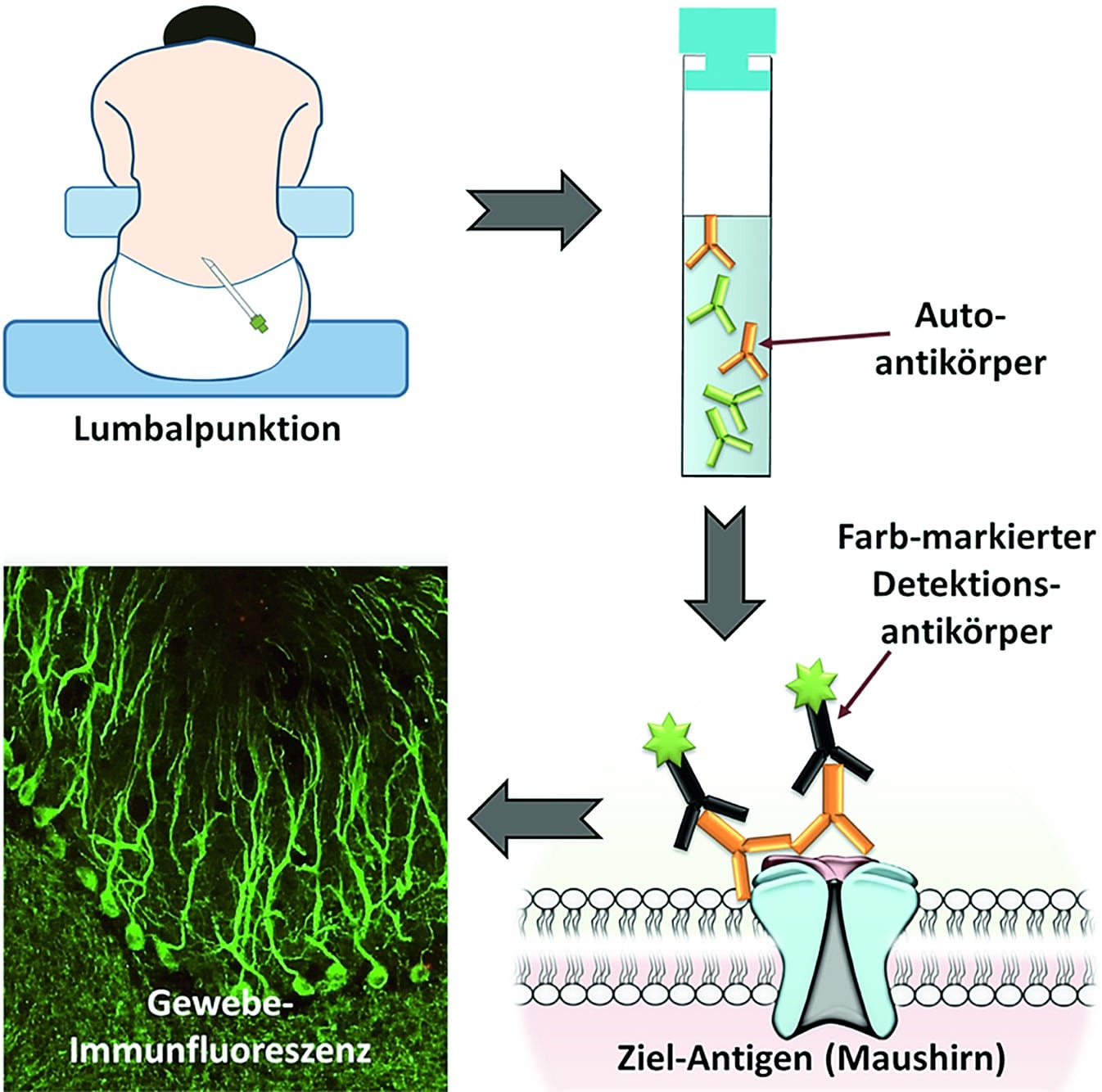 Abb. 1: Indirekte Immunfluoreszenz zur Detektion antineuronaler Autoantikörper; Abbildung von H.Prüß, www.neuropatterns.de