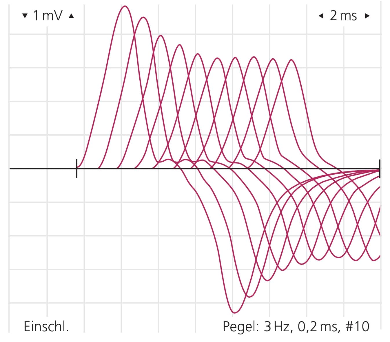 Abb. 1: Dekrement bei einem Patienten mit generalisierter Myasthenia gravis in der repetitiven Stimulation (3 Hz). Amplitudenreduktion von 31 % vom 1. auf 5. Reiz.