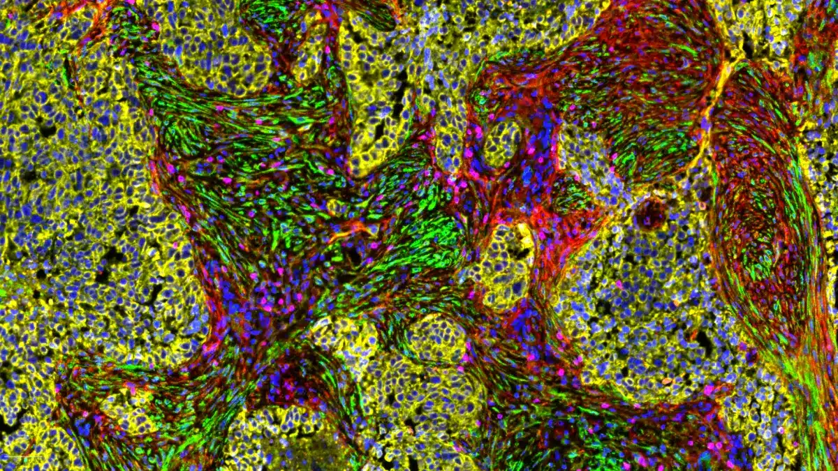 Multiplex-Immunfluoreszenz eines Tumorgewebes mit farblich markierten Fibroblasten, Immunzellen und Tumorzellen als Darstellung des Tumormikromilieus bei Lungen- und Eierstockkrebs