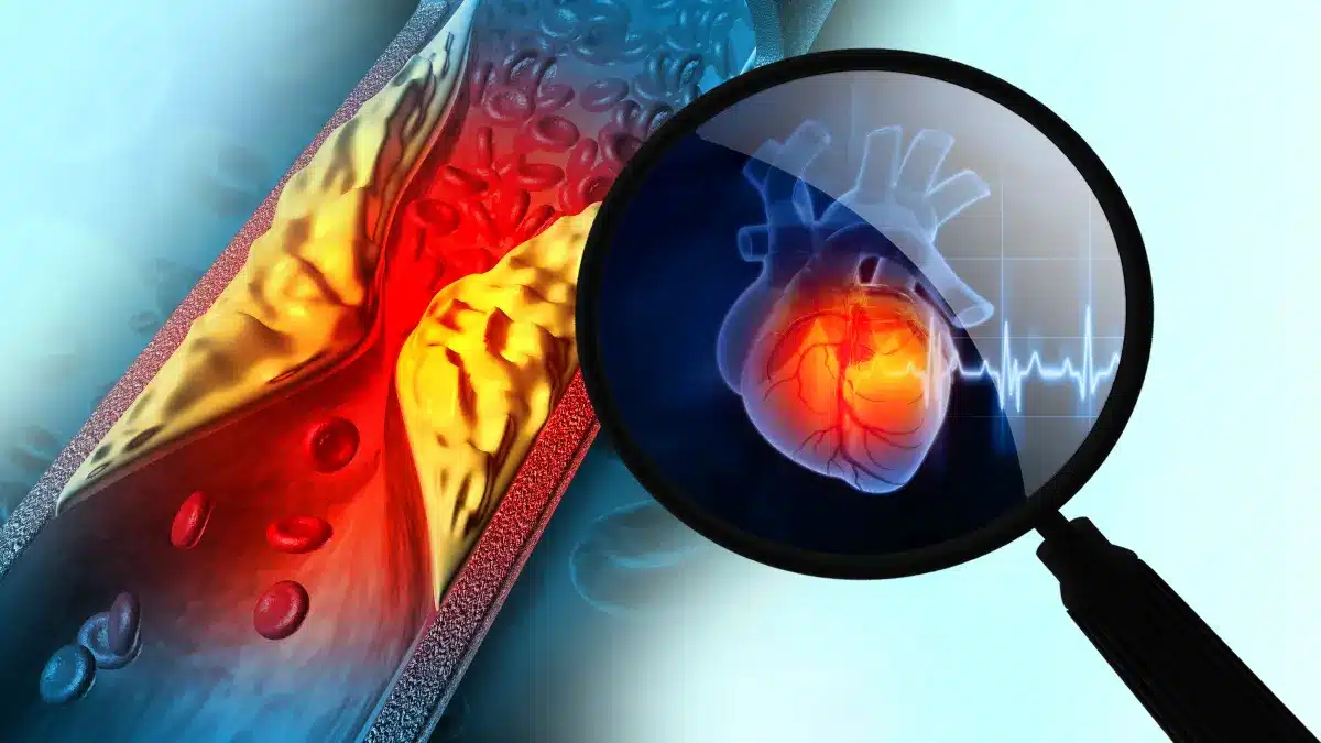 Medizinische Illustration einer durch Ablagerungen verengten Arterie und eines hervorgehobenen Herzens.