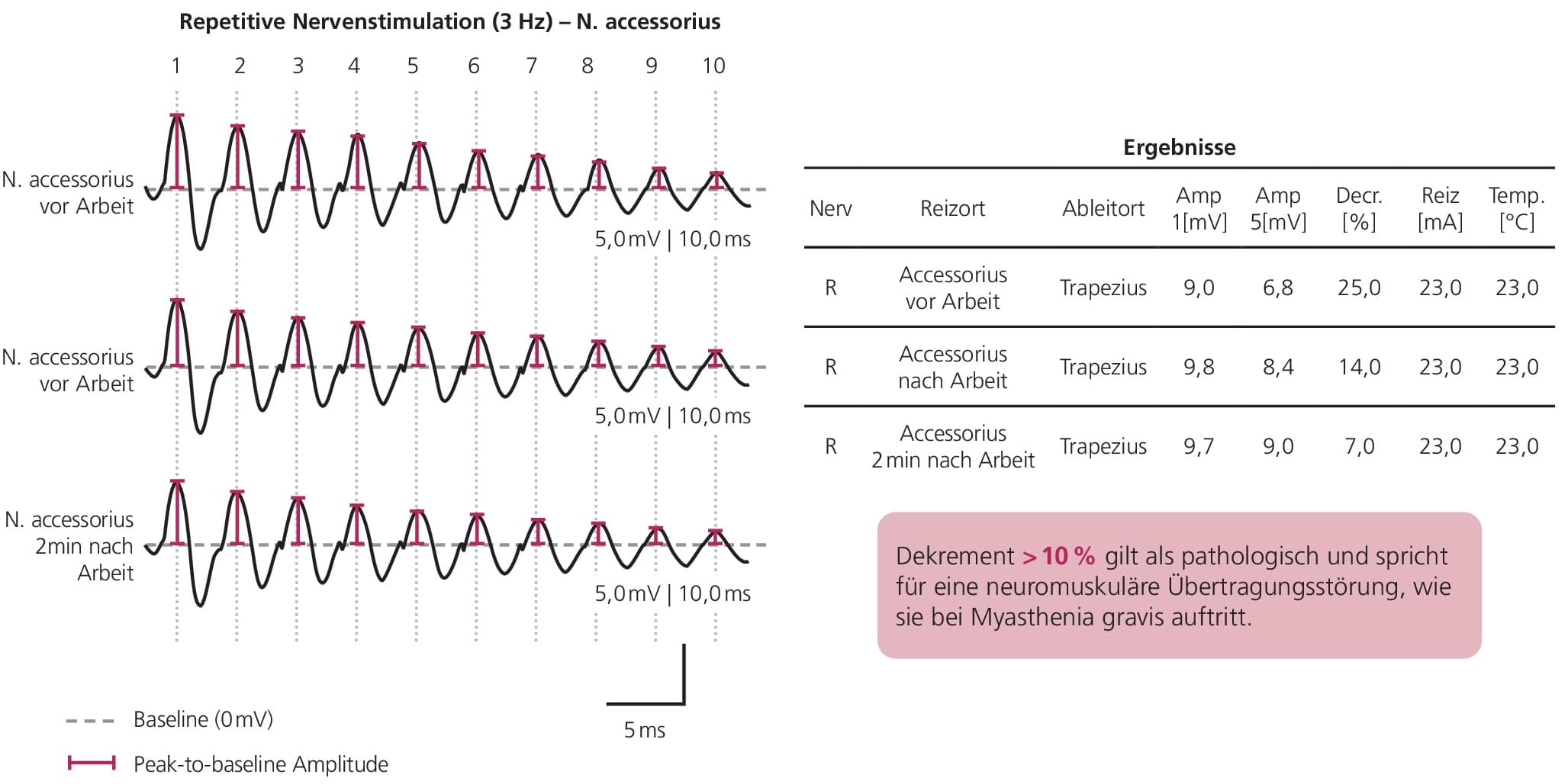 Abb. 1: Pathologisches Dekrement bei einer repetitiven niederfrequenten Nervenstimulation mit zwei bis drei Hertz. Eine Amplitudenabnahme von mindestens 10 % gilt als pathologischer Dekrementbefund und spricht für eine Störung der neuromuskulären Übertragung.