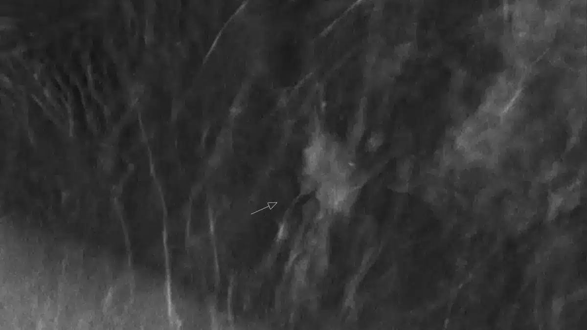 Mammografie-Aufnahme einer Brust mit Pfeilmarkierung im Brustkrebs-Screening